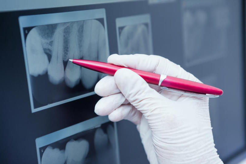 Are You Visiting Your Teeth Filling Dentist Regularly? Find Out Why You Should