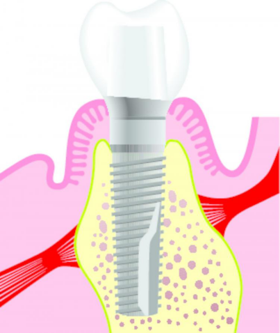 Image showing Aldie Root Canal Therapy