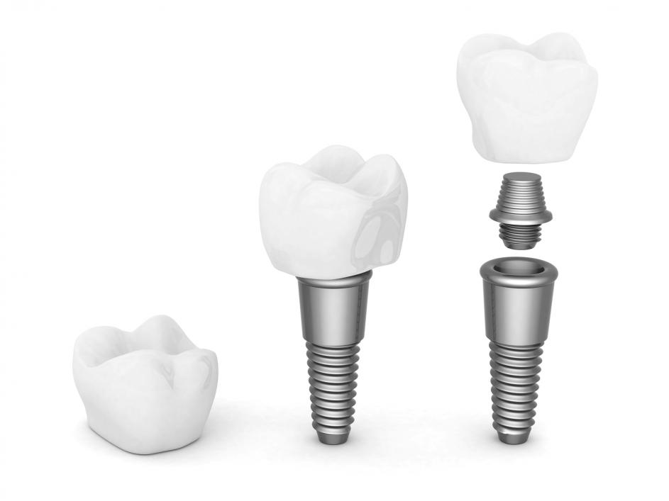 Image showing tooth implants