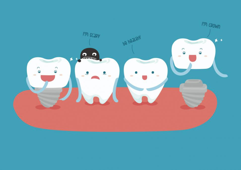 Everything you need to Know about Tooth Dental Implants